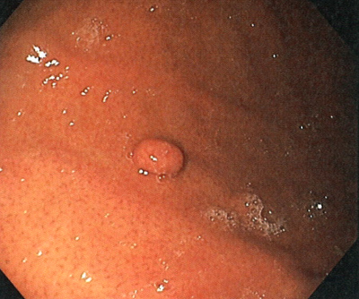 251116polyp.jpg